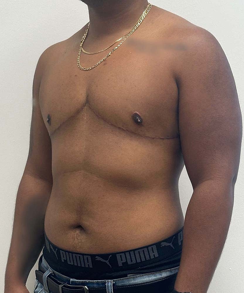 Ftm Top Surgery Before & After