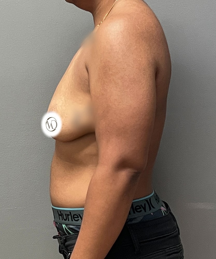 Ftm Top Surgery Before & After