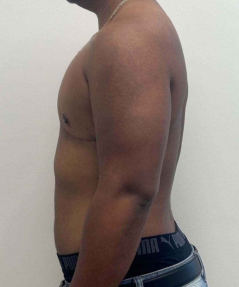 Ftm Top Surgery Before & After