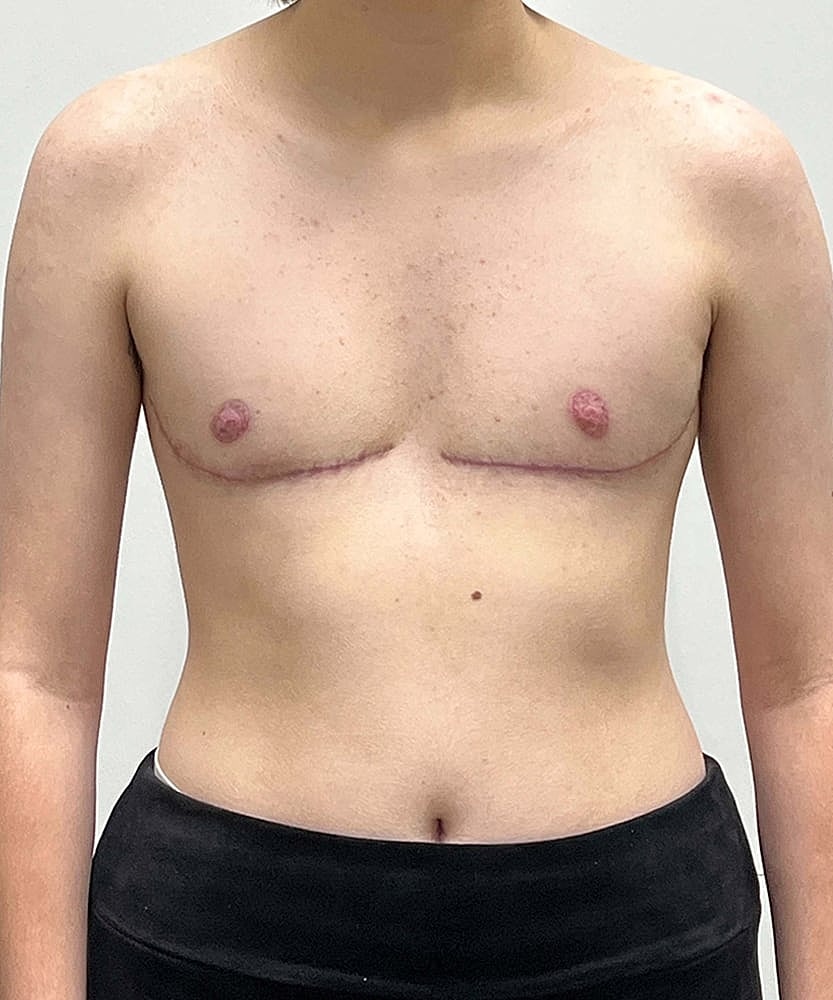 Ftm Top Surgery Before & After