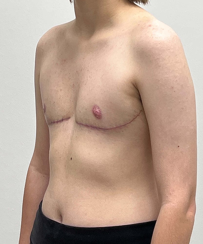 Ftm Top Surgery Before & After