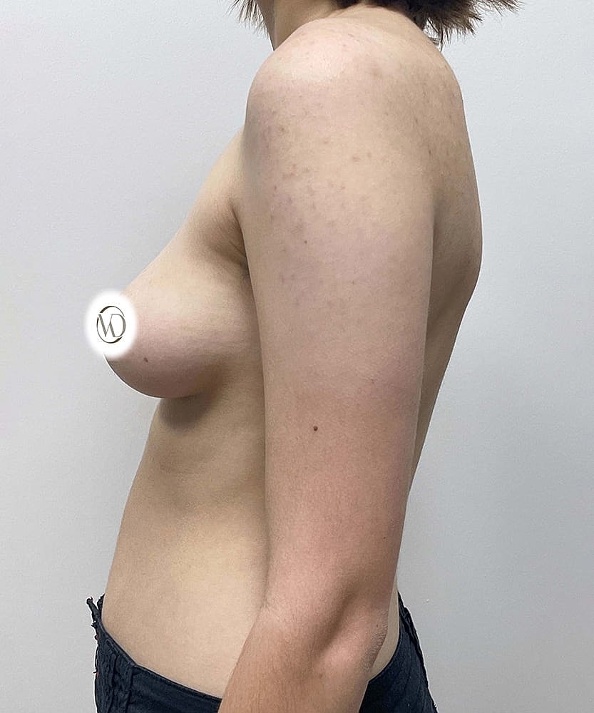 Ftm Top Surgery Before & After