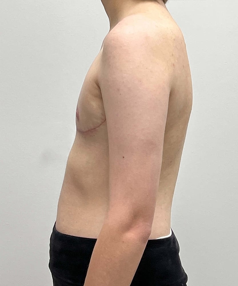 Ftm Top Surgery Before & After