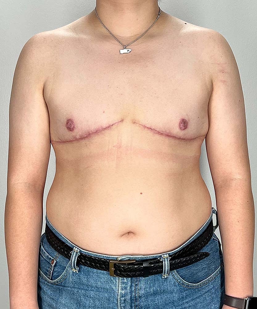 Ftm Top Surgery Before & After