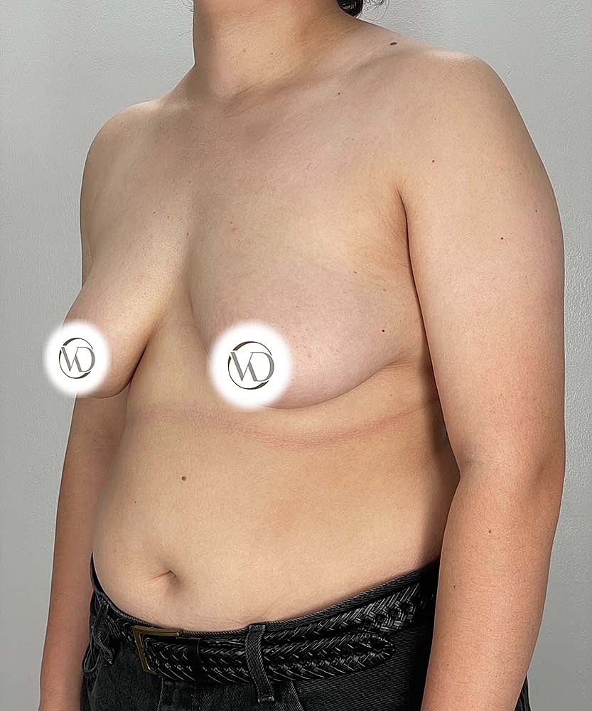 Ftm Top Surgery Before & After