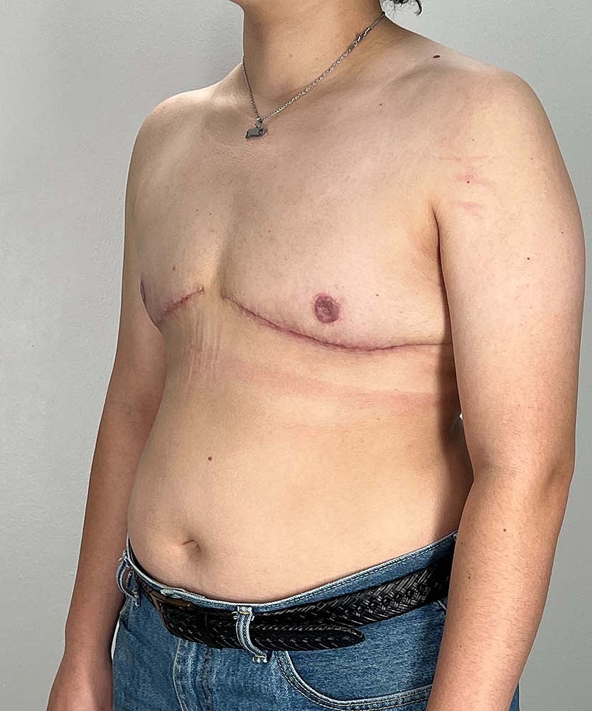 Ftm Top Surgery Before & After