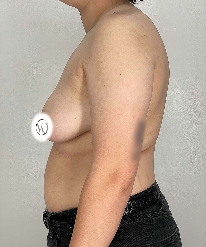 Ftm Top Surgery Before & After