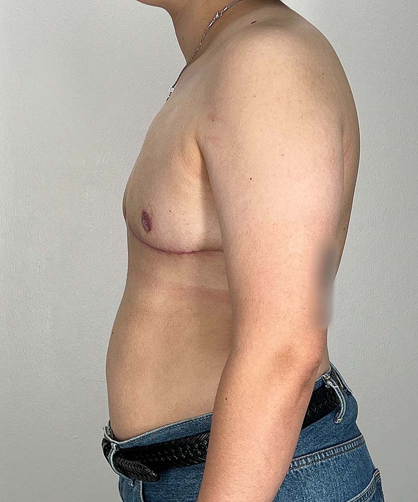 Ftm Top Surgery Before & After