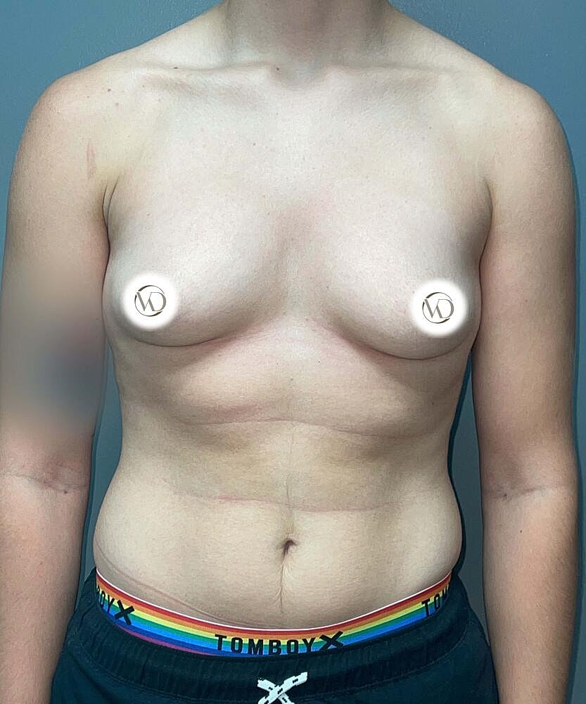 Ftm Top Surgery Before & After