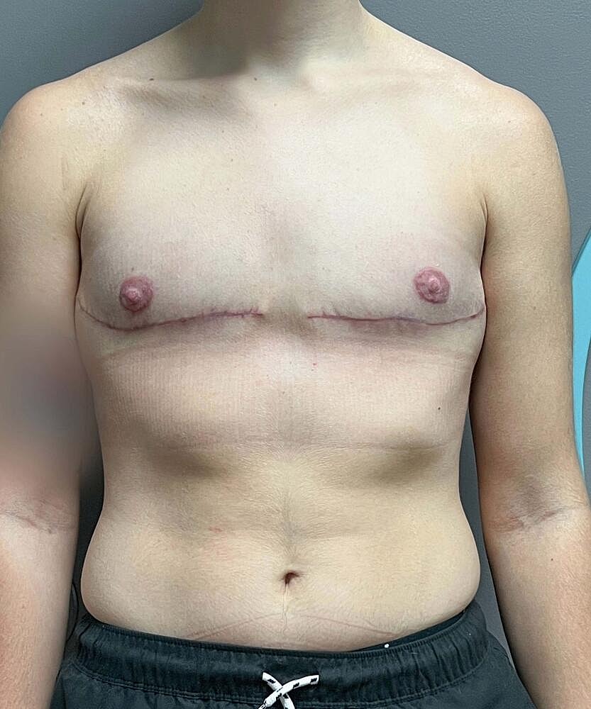 Ftm Top Surgery Before & After