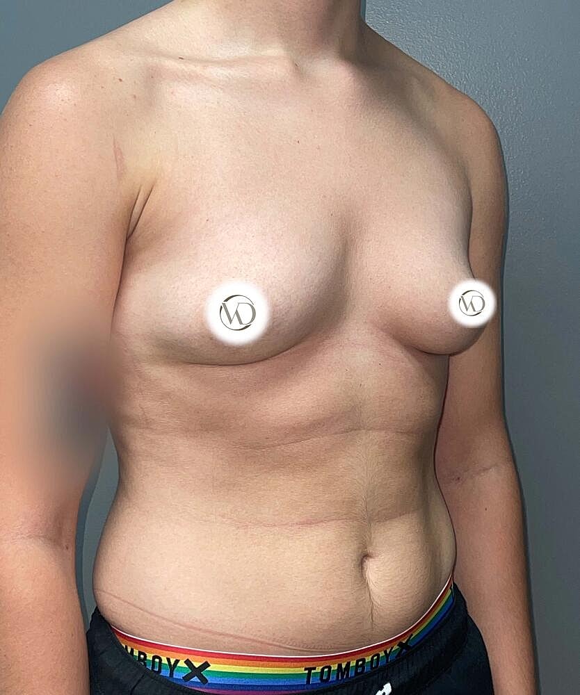 Ftm Top Surgery Before & After