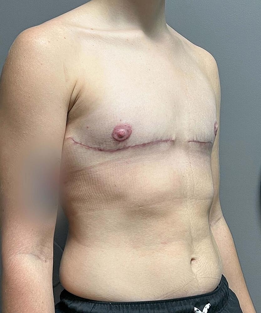 Ftm Top Surgery Before & After