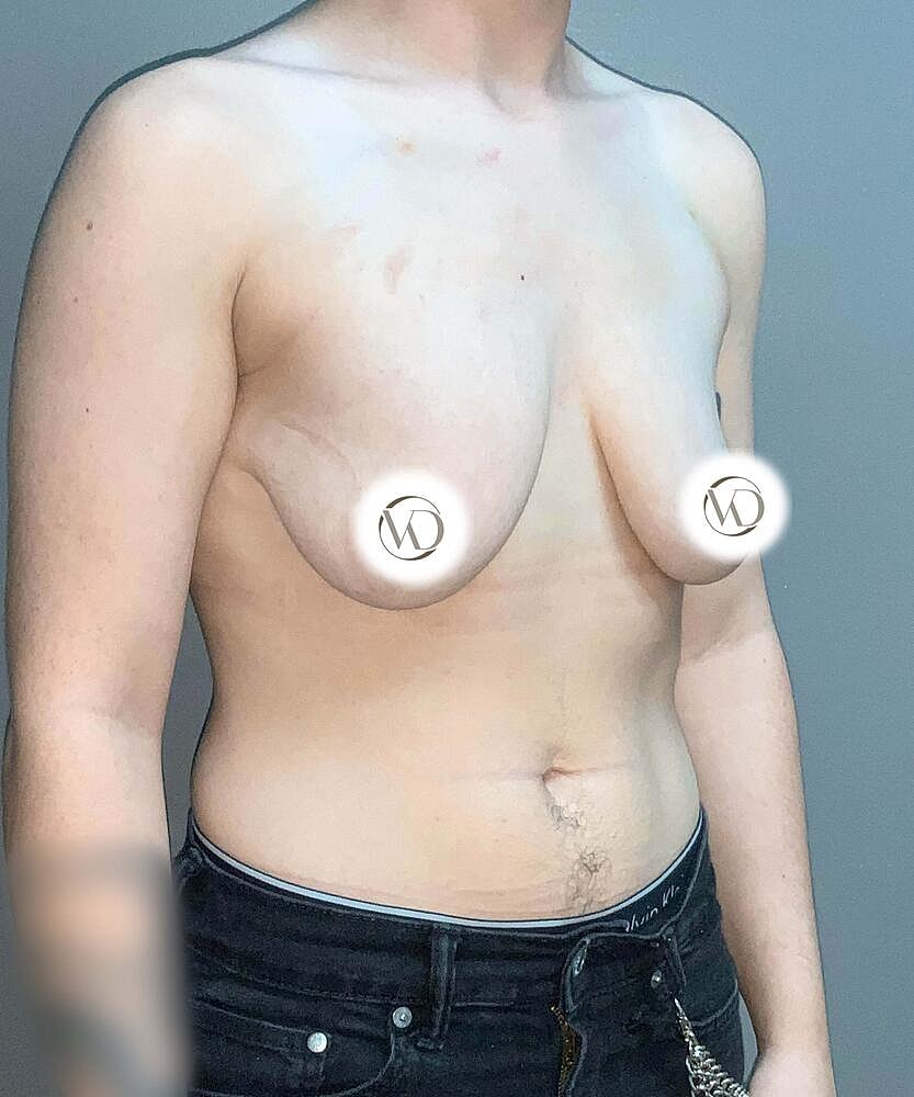 Ftm Top Surgery Before & After