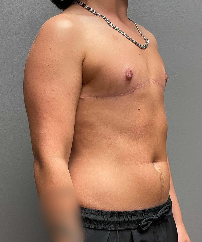 Ftm Top Surgery Before & After