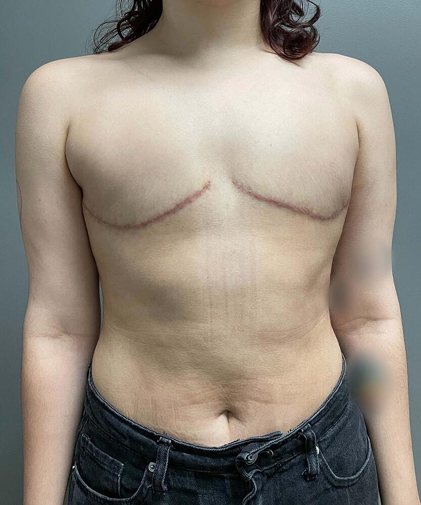 Ftm Top Surgery Before & After