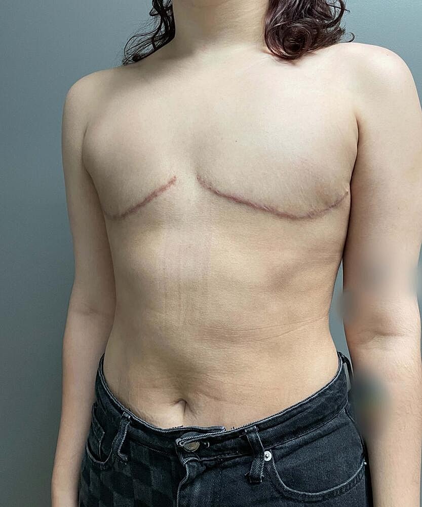 Ftm Top Surgery Before & After