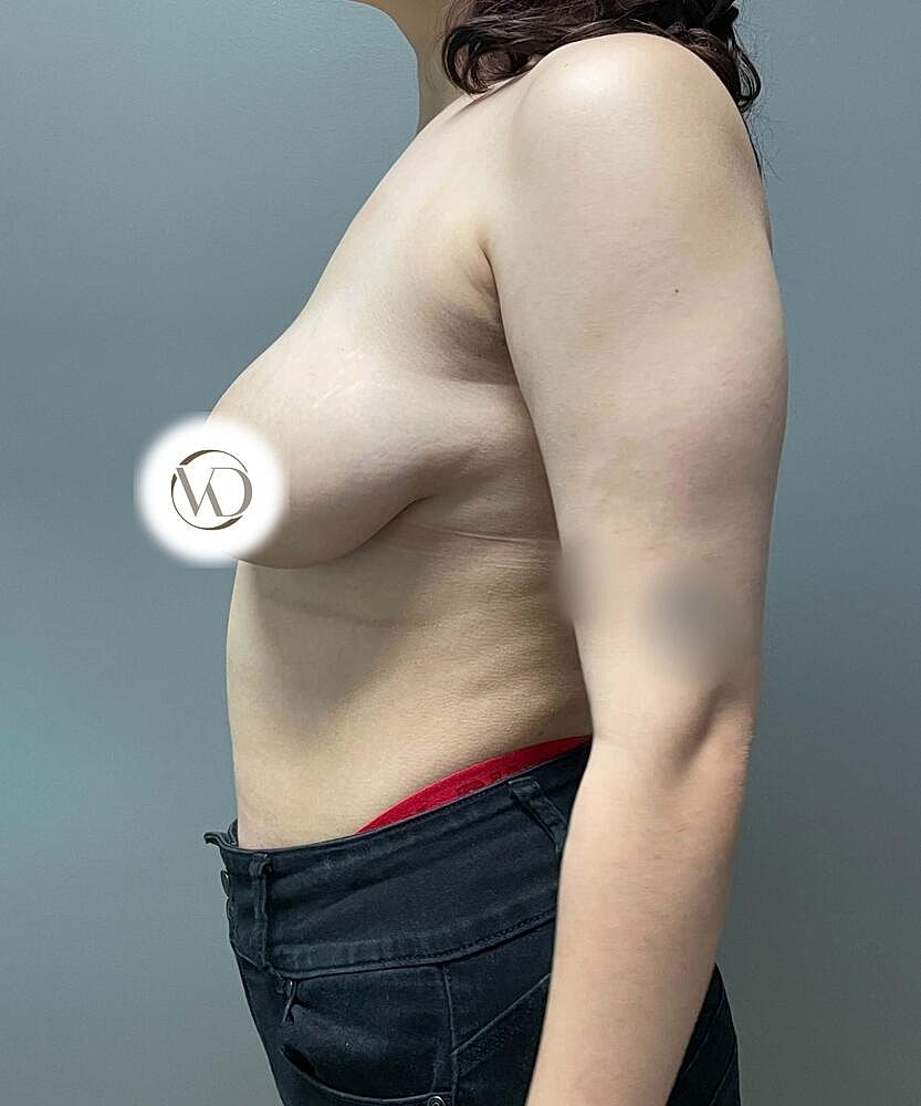 Ftm Top Surgery Before & After
