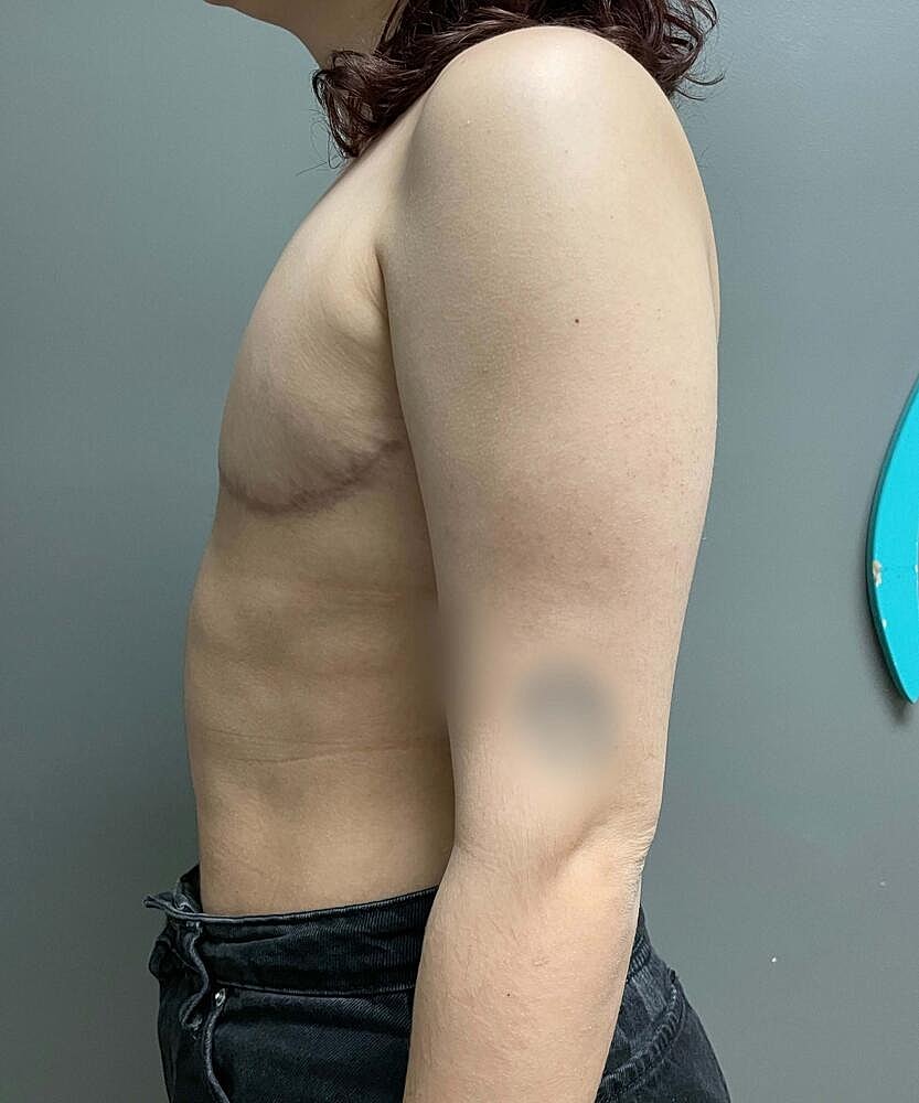 Ftm Top Surgery Before & After