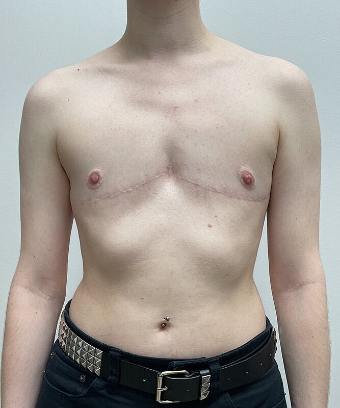 Ftm Top Surgery Before & After