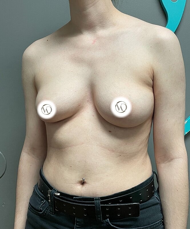 Ftm Top Surgery Before & After
