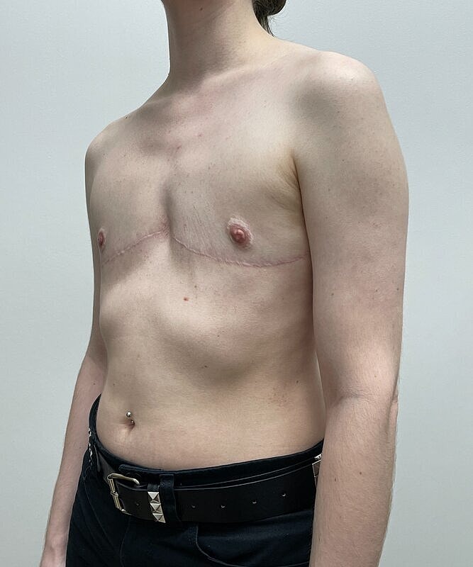 Ftm Top Surgery Before & After