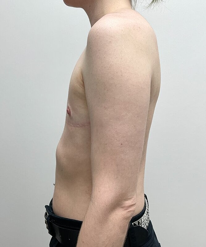 Ftm Top Surgery Before & After
