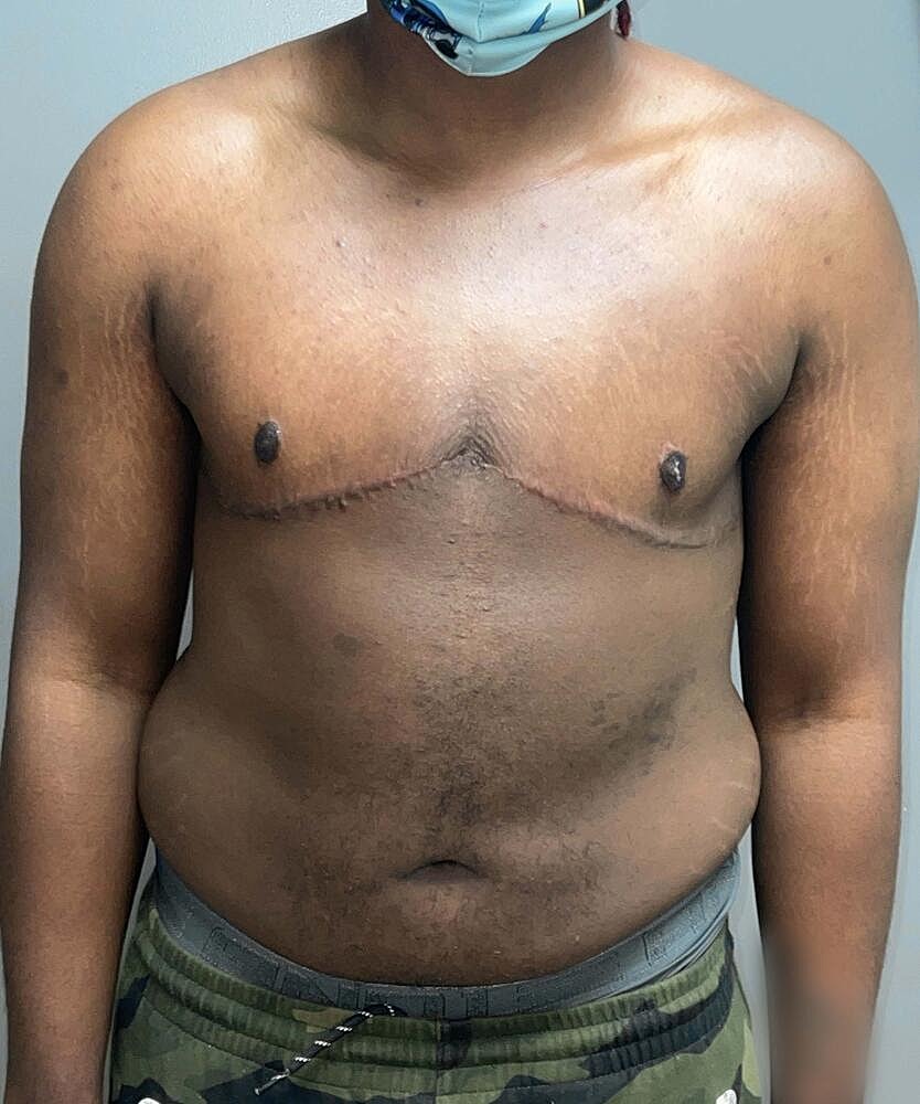 Ftm Top Surgery Before & After