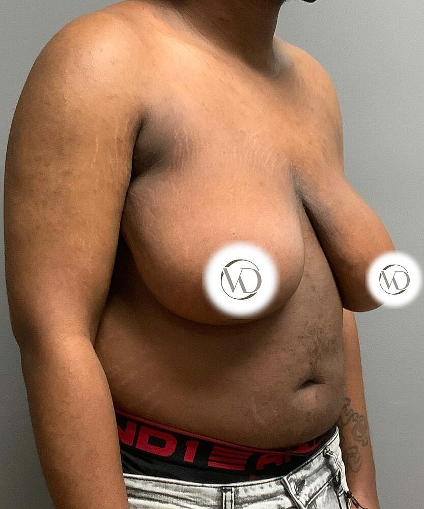 Ftm Top Surgery Before & After