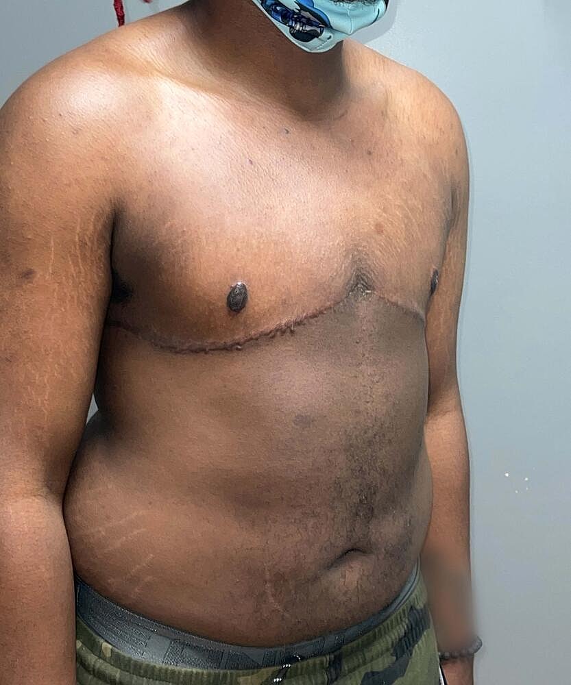 Ftm Top Surgery Before & After