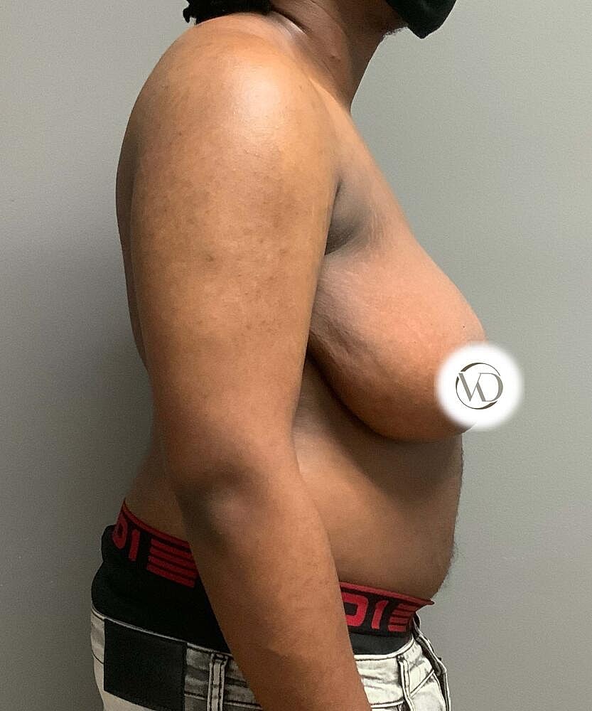 Ftm Top Surgery Before & After