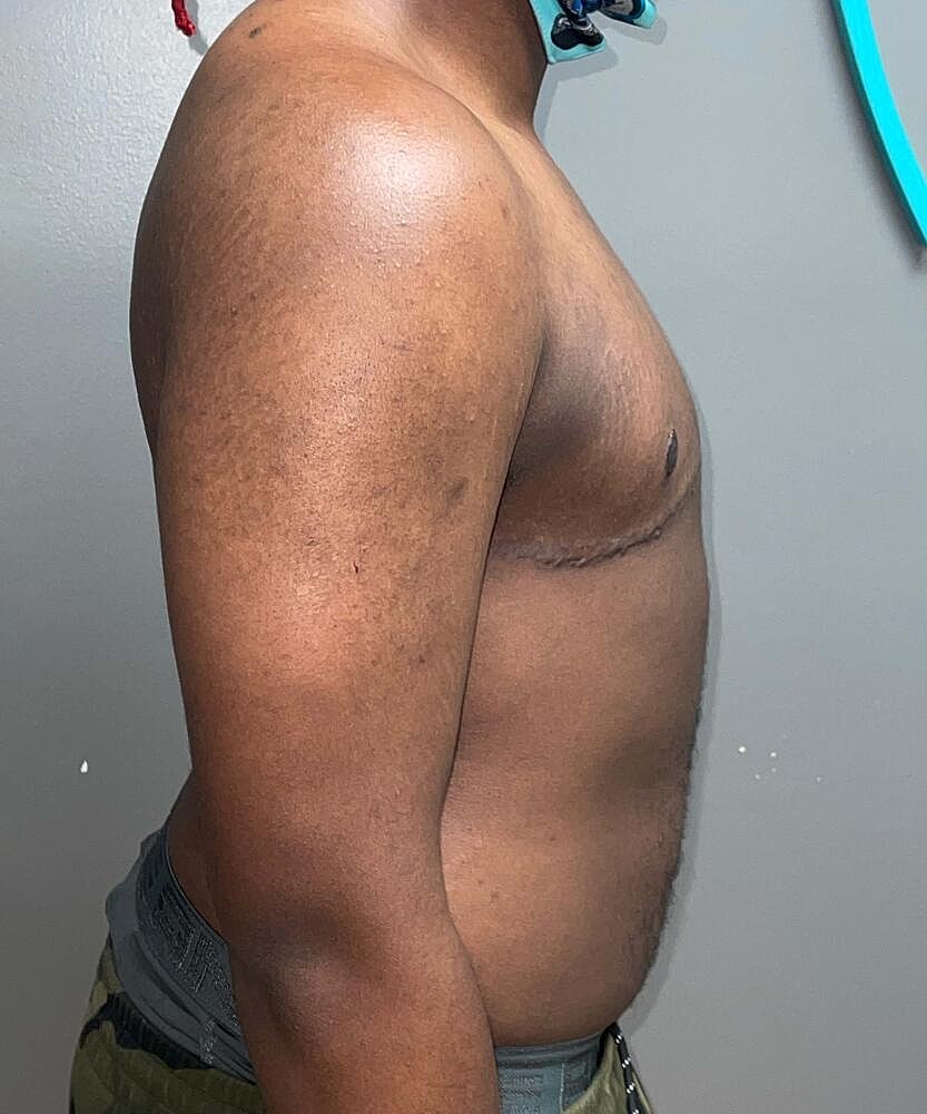 Ftm Top Surgery Before & After