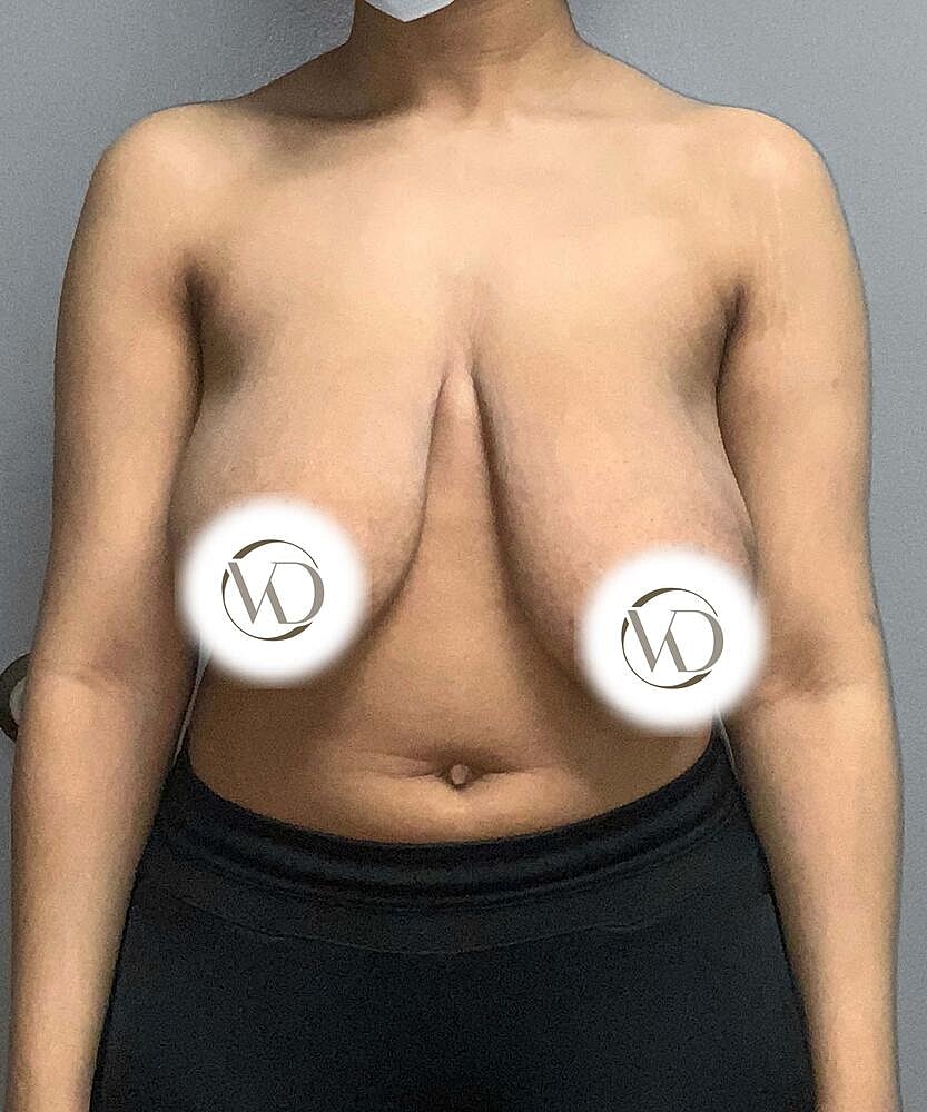 Ftm Top Surgery Before & After