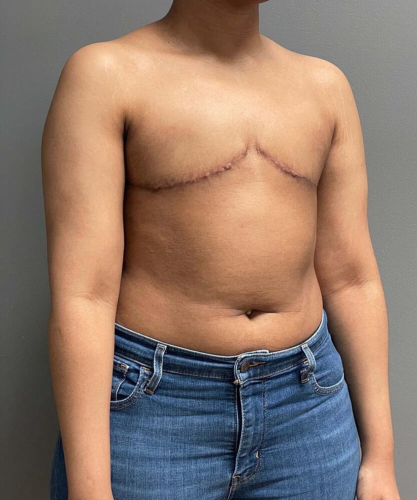 Ftm Top Surgery Before & After