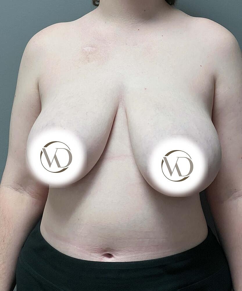 Ftm Top Surgery Before & After