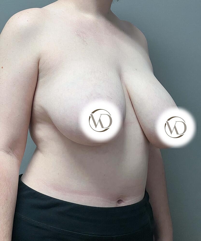 Ftm Top Surgery Before & After