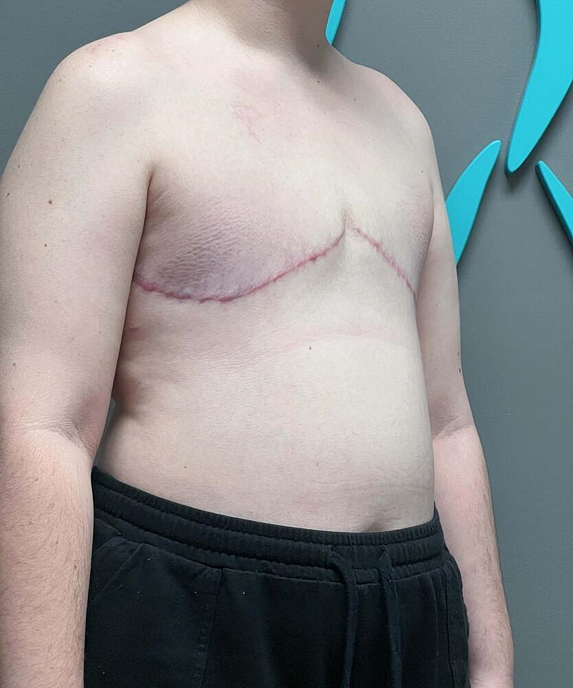 Ftm Top Surgery Before & After