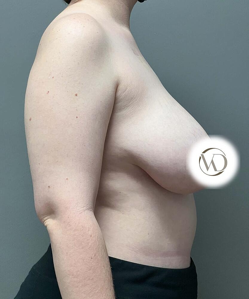 Ftm Top Surgery Before & After