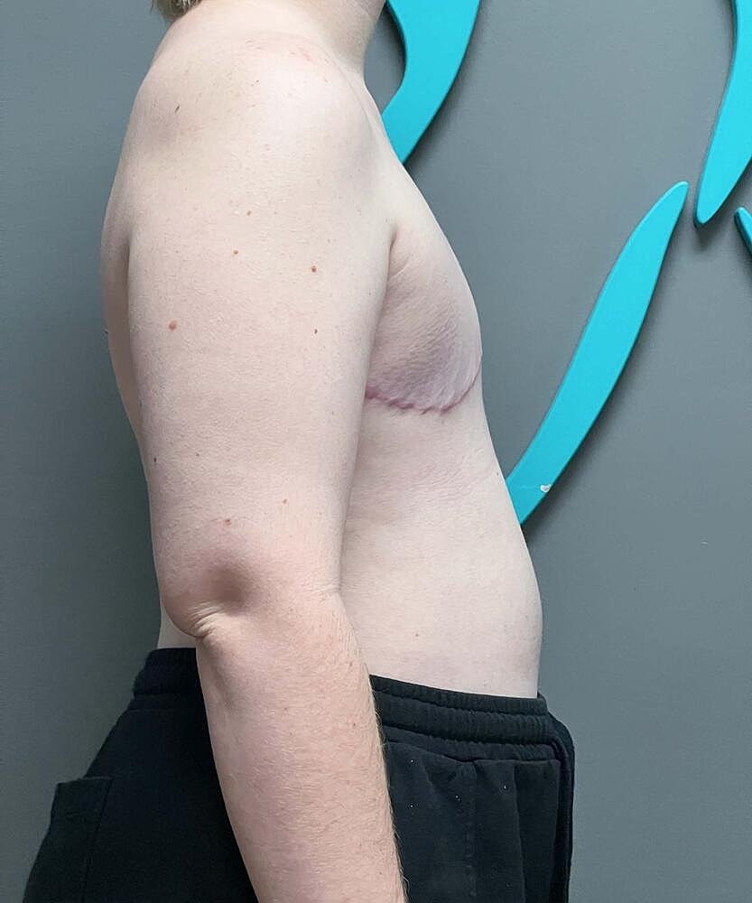 Ftm Top Surgery Before & After
