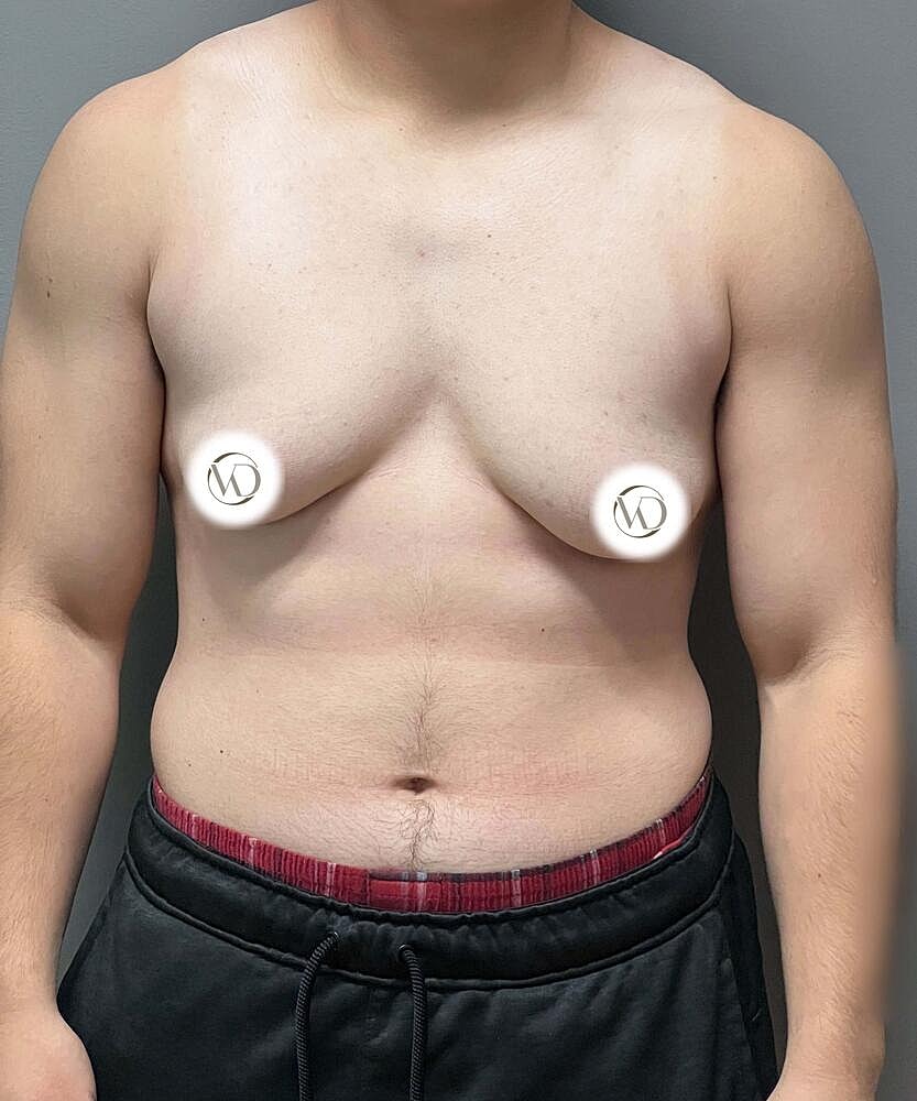 Ftm Top Surgery Before & After
