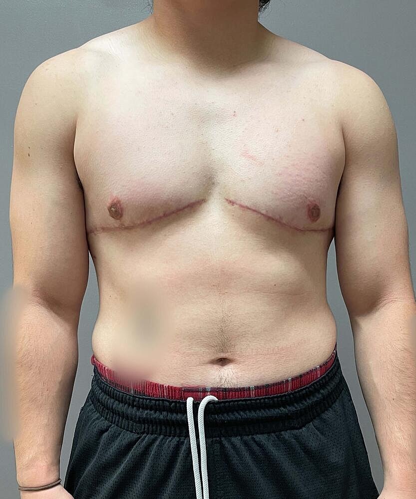 Ftm Top Surgery Before & After