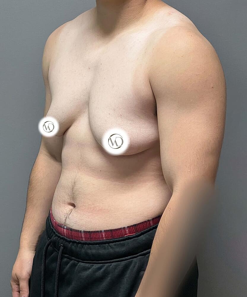 Ftm Top Surgery Before & After