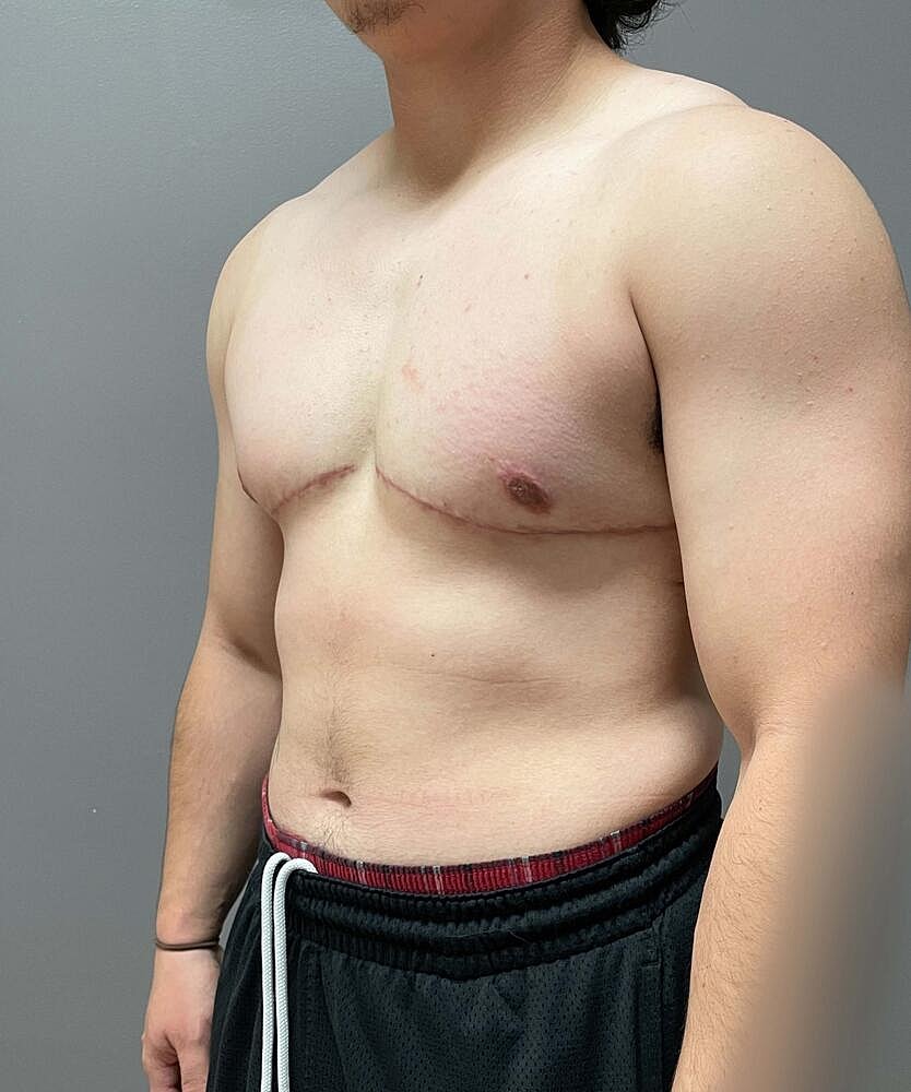 Ftm Top Surgery Before & After