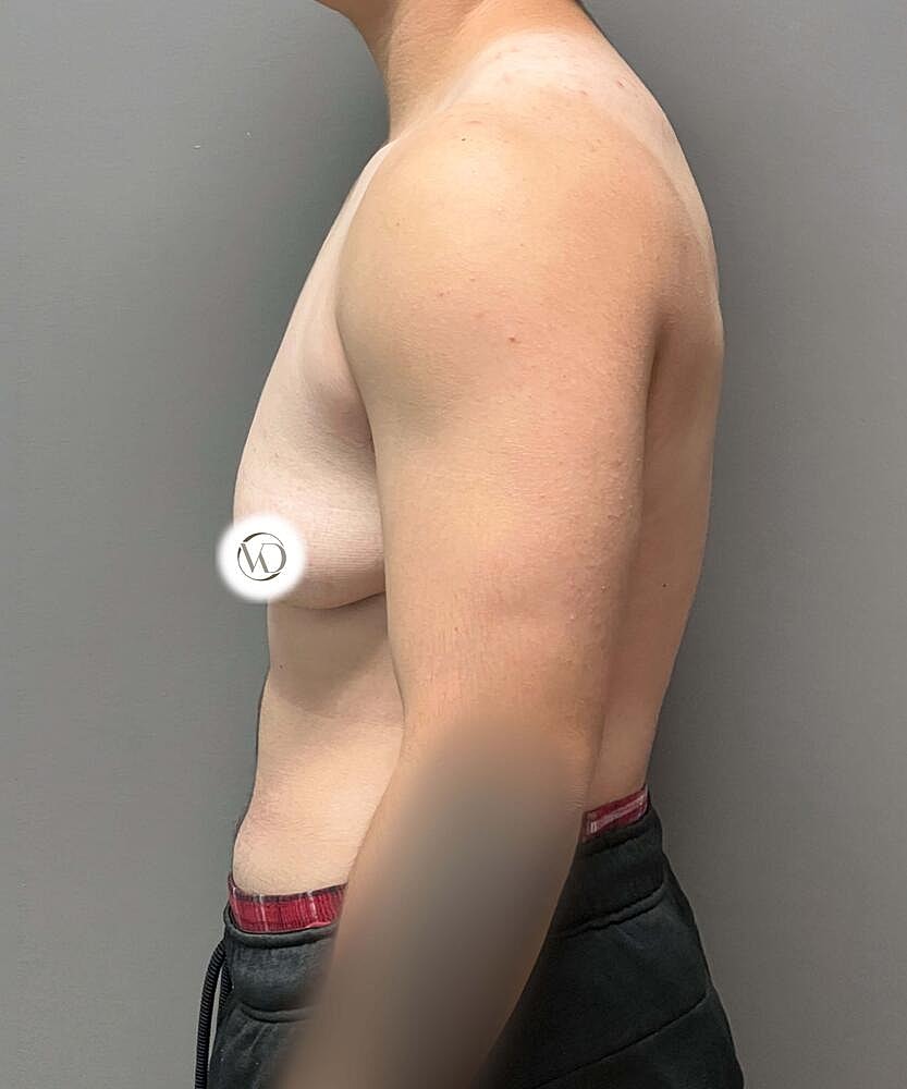 Ftm Top Surgery Before & After
