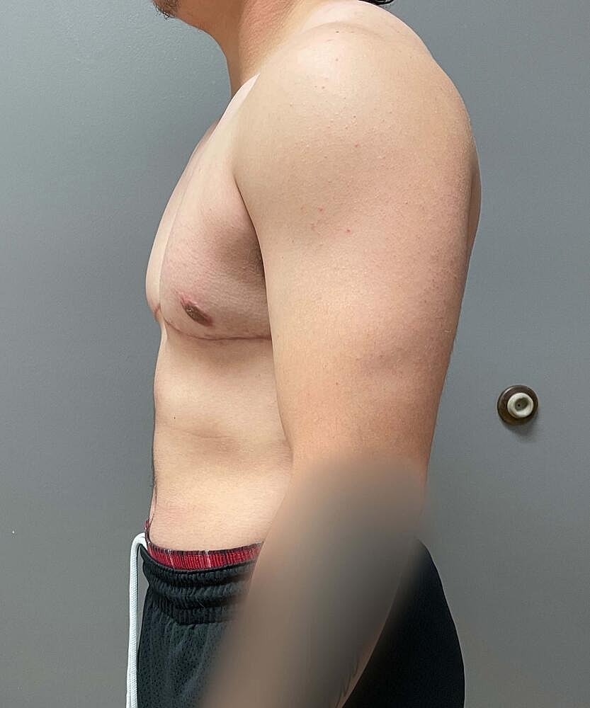 Ftm Top Surgery Before & After