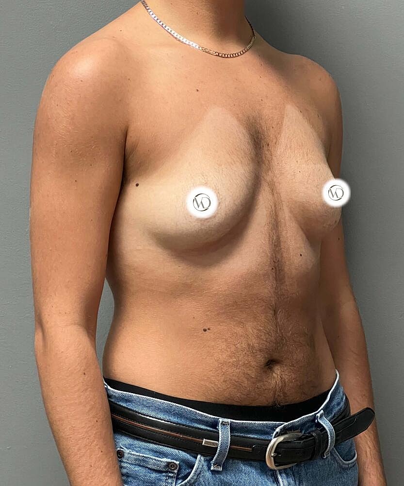 Ftm Top Surgery Before & After