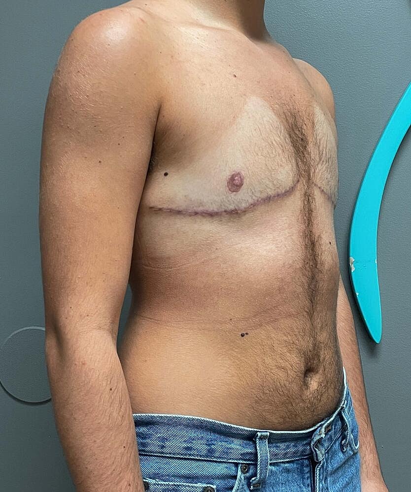 Ftm Top Surgery Before & After
