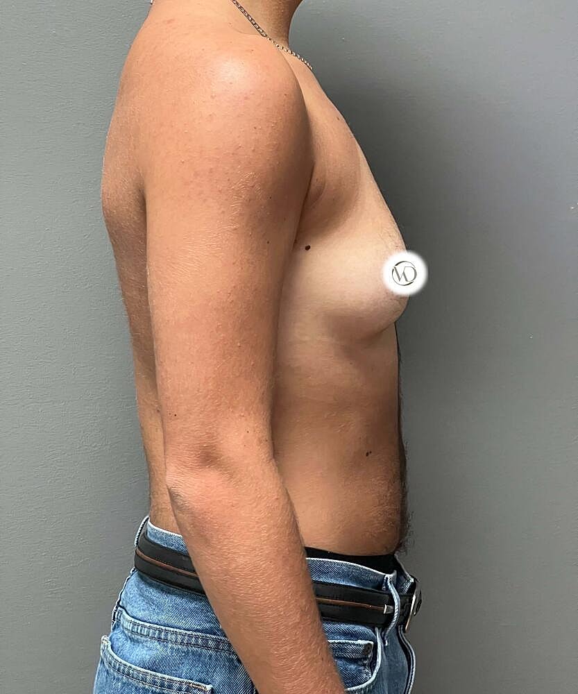 Ftm Top Surgery Before & After