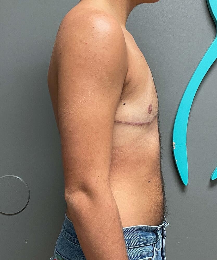 Ftm Top Surgery Before & After