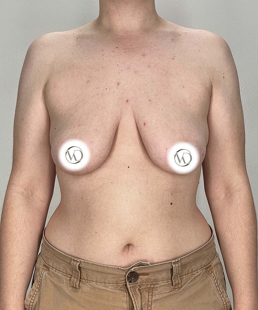Ftm Top Surgery Before & After