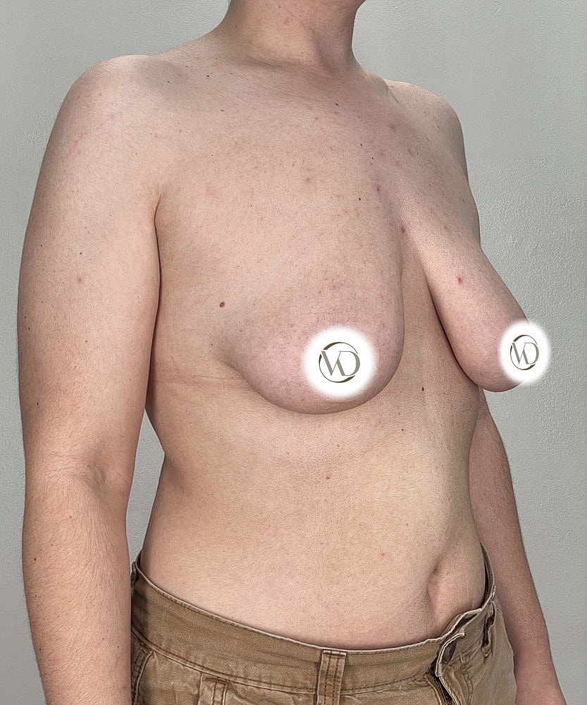 Ftm Top Surgery Before & After